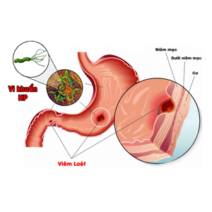 Bệnh lý liên quan đến dạ dày